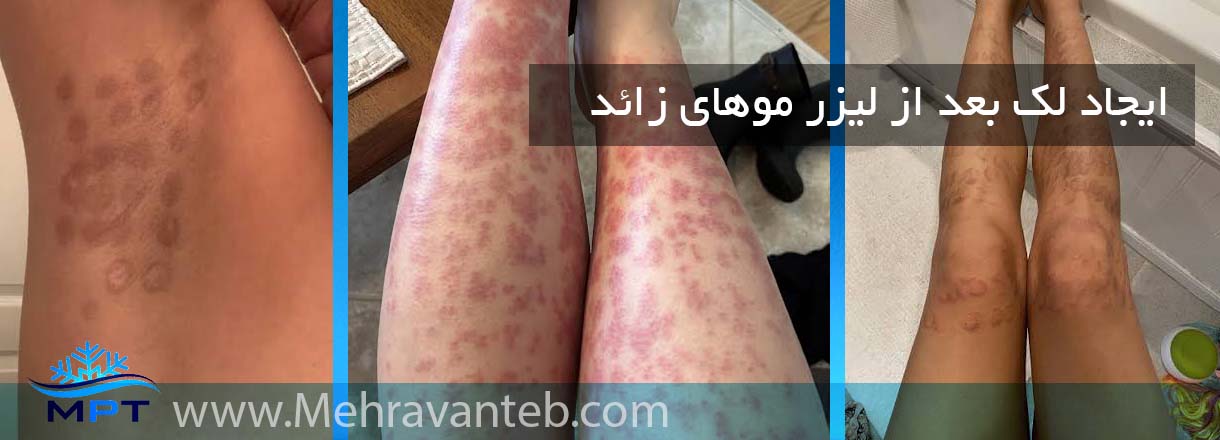 ایجاد لک بعد از لیزر موهای زائد